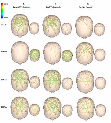 Functional Connectivity Derived From Electroencephalogram in Pharmacoresistant Epileptic Encephalopathy Using Cannabidiol as Adjunctive Antiepileptic Therapy